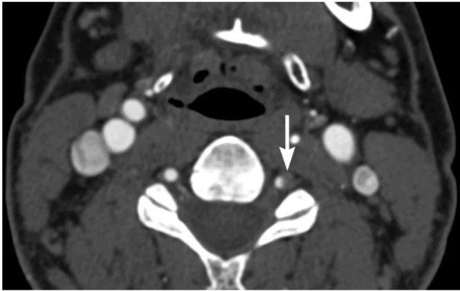 Vertebral arter diseksiyonu: yayımlanmış olgu görüntüsü, aksiyel kesit