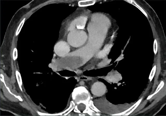 Pulmoner arter dolum defekti diğer taklitçileri: yayımlanmış olgu görüntüsü, aksiyel kesit