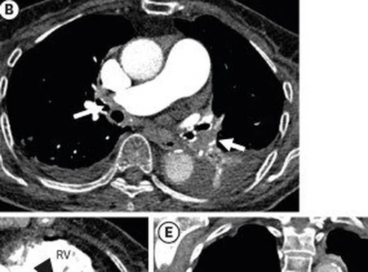 Akut pulmoner emboli: yayımlanmış olgu görüntüsü, aksiyel kesit