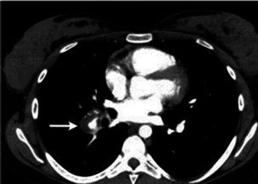 Behçet hastalığında pulmoner arter tutulumu: yayımlanmış olgu görüntüsü, aksiyel kesit