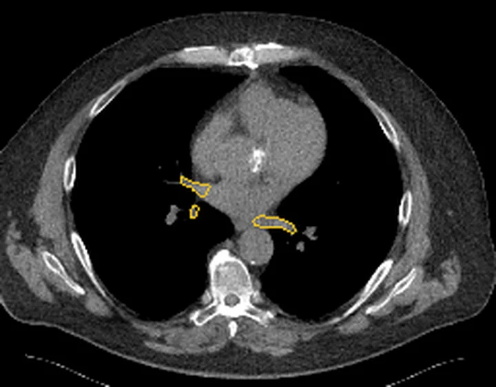 Bölge anatomisi, BT kesiti: Pulmoner arter sınırı sarı çizgiyle işaretli