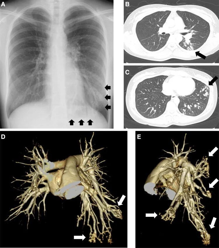 Multipl ve diffüz pulmoner AVM: yayımlanmış olgu görüntüsü, 3B kesit