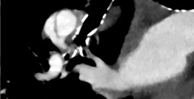 Kronik tromboembolik pulmoner hastalık: yayımlanmış olgu görüntüsü, aksiyel kesit
