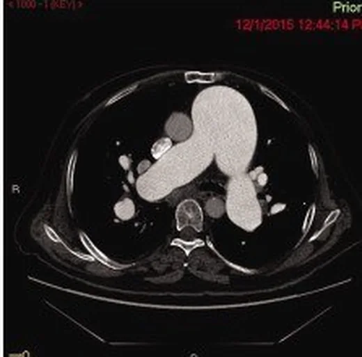 Pulmoner arter anevrizması: yayımlanmış olgu görüntüsü, aksiyel kesit