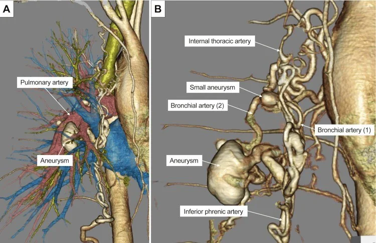 Pulmoner arter-bronşiyal arter fistülü: yayımlanmış olgu görüntüsü, 3B kesit