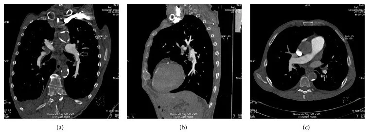 Pulmoner arter diseksiyonu: yayımlanmış olgu görüntüsü, aksiyel kesit