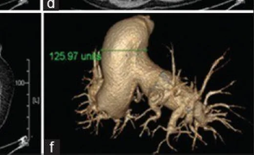 İdiyopatik pulmoner arter dilatasyonu: yayımlanmış olgu görüntüsü, aksiyel kesit