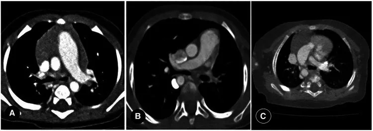 Pulmoner arter hipoplazisi veya proksimal kesintisi: yayımlanmış olgu görüntüsü, aksiyel kesit