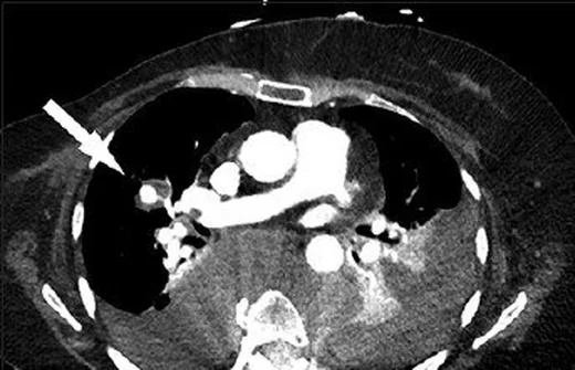 Pulmoner arter psödoanevrizması: yayımlanmış olgu görüntüsü, aksiyel kesit
