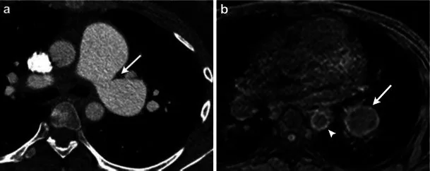 Pulmoner arter vasküliti: yayımlanmış olgu görüntüsü, aksiyel kesit