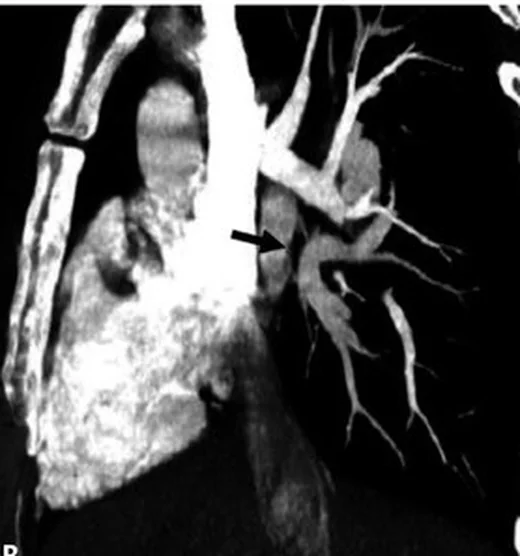 Pulmoner AVM taklitçileri: yayımlanmış olgu görüntüsü, aksiyel kesit