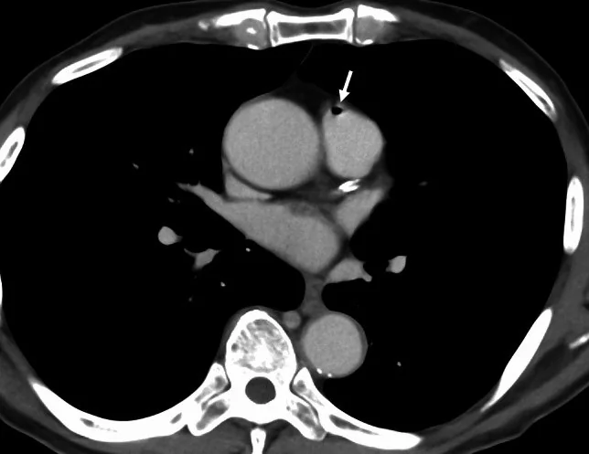 Pulmoner hava embolisi: yayımlanmış olgu görüntüsü, aksiyel kesit
