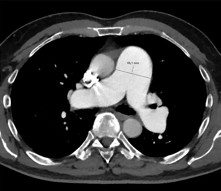 Pulmoner hipertansiyonun BT bulguları: yayımlanmış olgu görüntüsü, aksiyel kesit