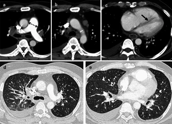 Pulmoner tümör embolisi ve tümör trombotik mikroanjiyopatisi: yayımlanmış olgu görüntüsü, aksiyel kesit
