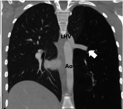 Parsiyel anormal pulmoner venöz dönüş: yayımlanmış olgu görüntüsü, koronal kesit