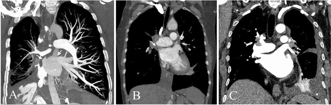 Pulmoner venöz oklüzyon ve konjesyon örüntüsü: yayımlanmış olgu görüntüsü, koronal kesit