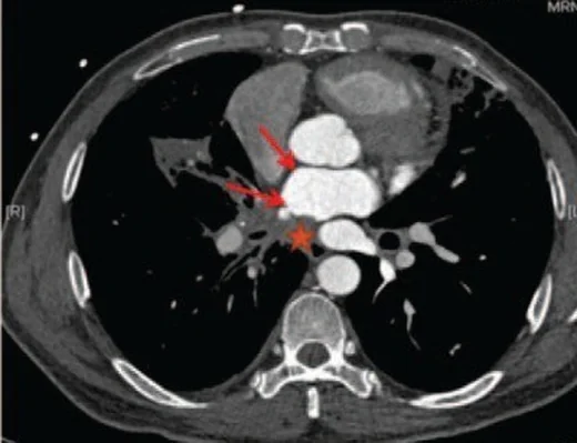 Pulmoner ven stenozu: yayımlanmış olgu görüntüsü, aksiyel kesit