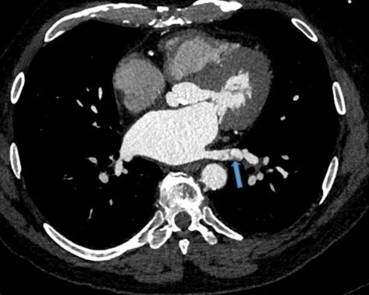 Pulmoner ven trombozu: yayımlanmış olgu görüntüsü, aksiyel kesit