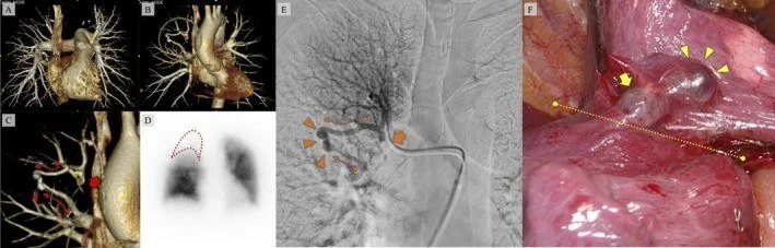Pulmoner ven variksi: yayımlanmış olgu görüntüsü, 3B kesit