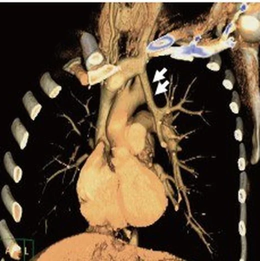 Pulmoner venöz anatomi varyantları: yayımlanmış olgu görüntüsü, koronal kesit