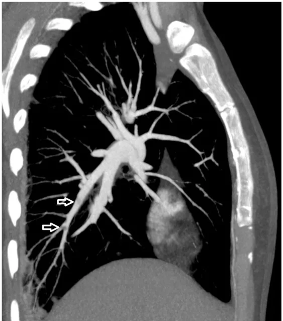 Pulmoner yağ embolisi: yayımlanmış olgu görüntüsü, aksiyel kesit