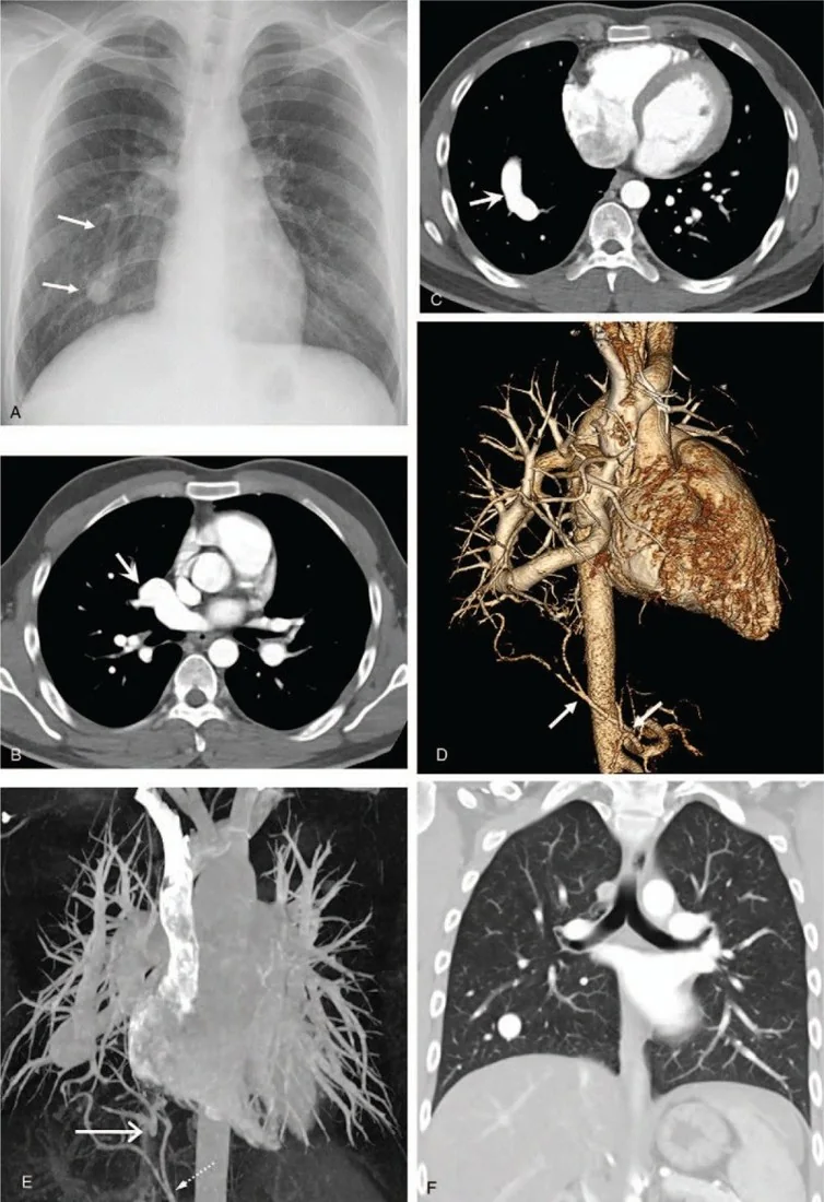 Meandering pulmoner ven ve pseudo-scimitar görünümü: yayımlanmış olgu görüntüsü, aksiyel kesit