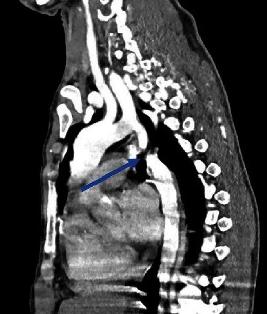 Aort arkusu kesintisi: yayımlanmış olgu görüntüsü, sagittal kesit