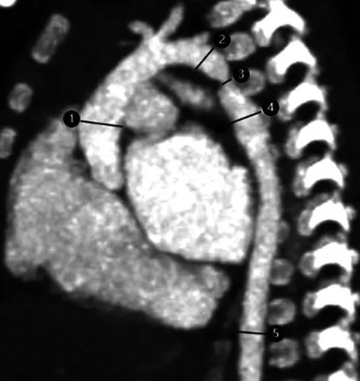 Aort koarktasyonu: yayımlanmış olgu görüntüsü, sagittal kesit