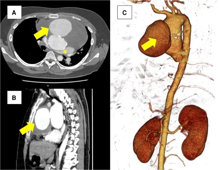 Aort psödoanevrizması: yayımlanmış olgu görüntüsü, aksiyel+sagittal+3B kesit
