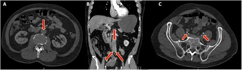 Aortogreft trombozu veya oklüzyonu: yayımlanmış olgu görüntüsü, aksiyel+koronal kesit