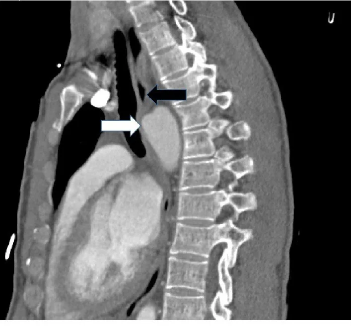 Duktus divertikülü: yayımlanmış olgu görüntüsü, sagittal kesit