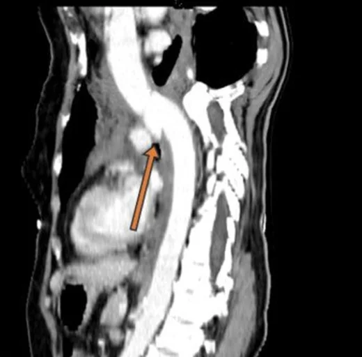 Künt travmatik aort yaralanması: yayımlanmış olgu görüntüsü, aksiyel+sagittal kesit