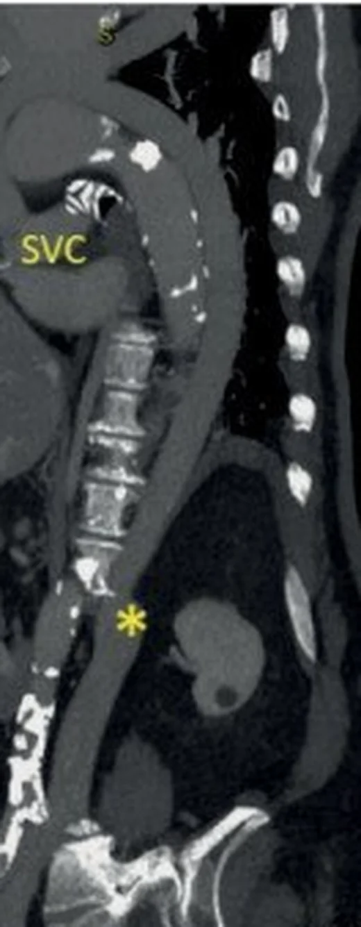 Azygos/hemiazygos devamlılığı: yayımlanmış olgu görüntüsü, sagittal kesit