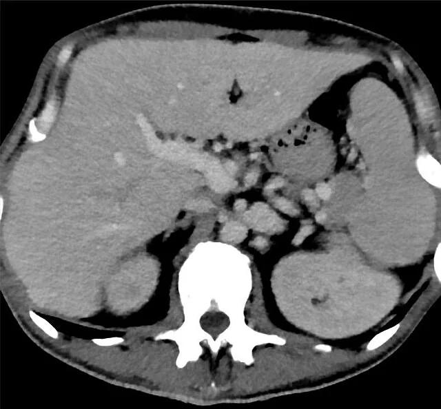 Anterior Nutcracker sendromu: yayımlanmış olgu görüntüsü, aksiyel+sagittal kesit