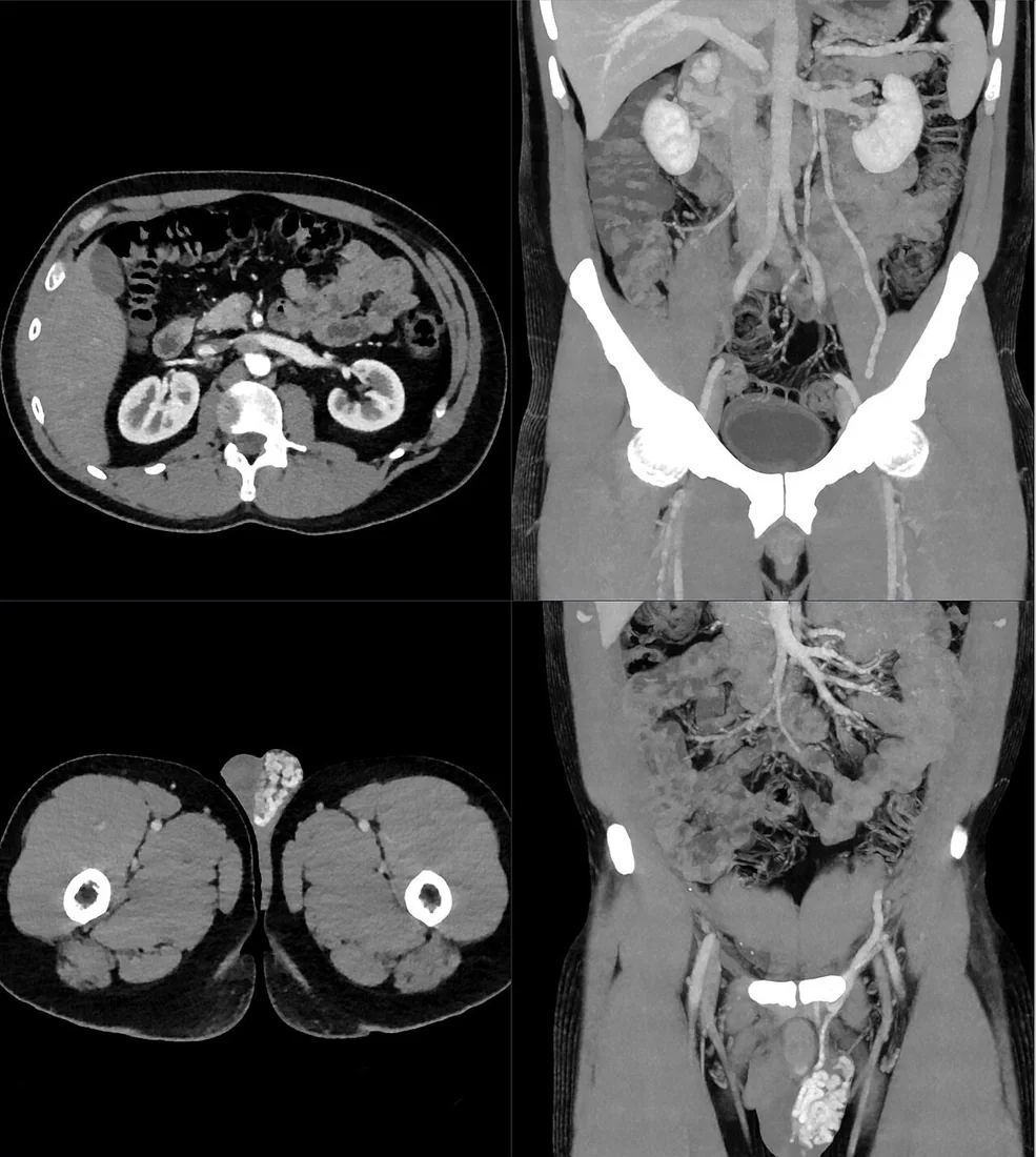 Renal ven kompresyonu ve venöz kollateraller: yayımlanmış olgu görüntüsü, aksiyel+koronal kesit