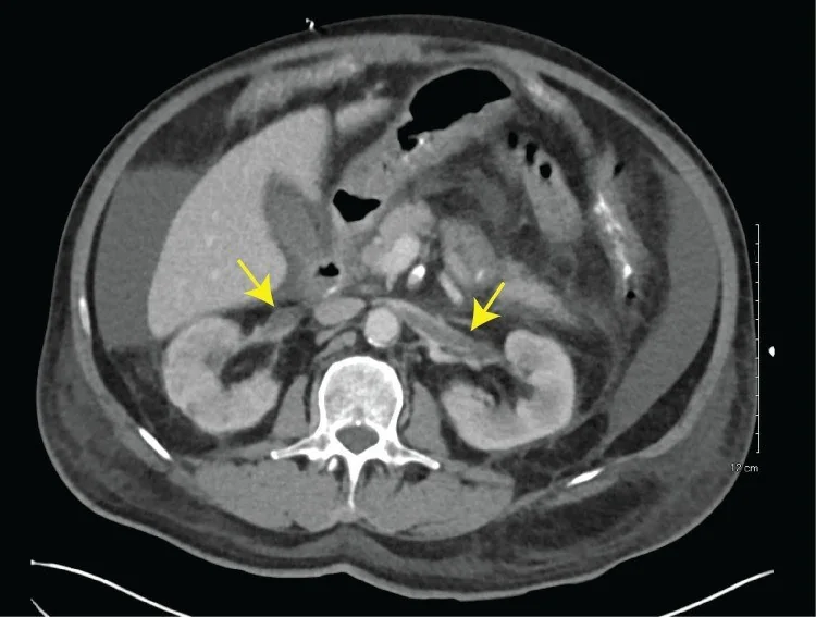 Renal ven trombozu: yayımlanmış olgu görüntüsü, aksiyel kesit