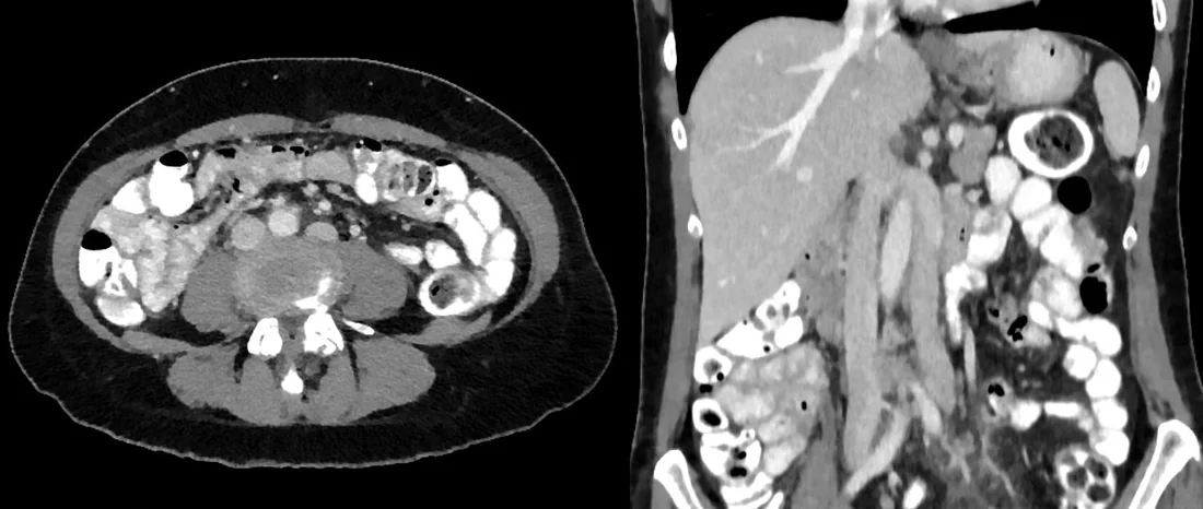 Renal ven sayısı ve drenaj varyantları: yayımlanmış olgu görüntüsü, aksiyel+koronal kesit
