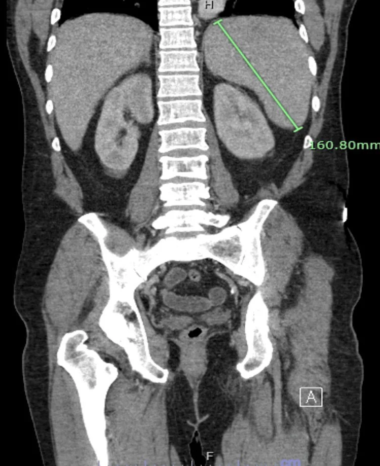 Hemofagositik lenfohistiyositozda retiküloendotelyal tutulum: yayımlanmış olgu görüntüsü, koronal kesit