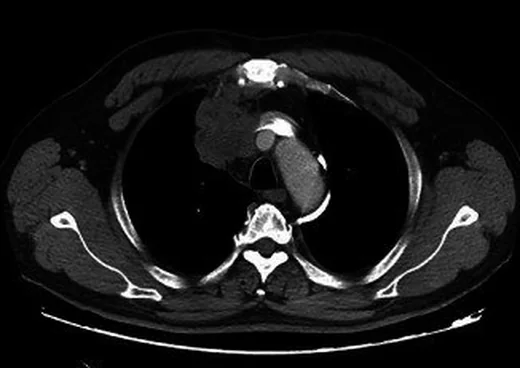 Primer mediastinal büyük B hücreli lenfoma: yayımlanmış olgu görüntüsü, aksiyel kesit
