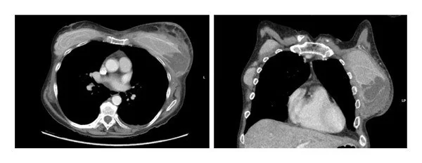 Peri-implant sıvı koleksiyonu: yayımlanmış olgu görüntüsü, aksiyel ve koronal kesit
