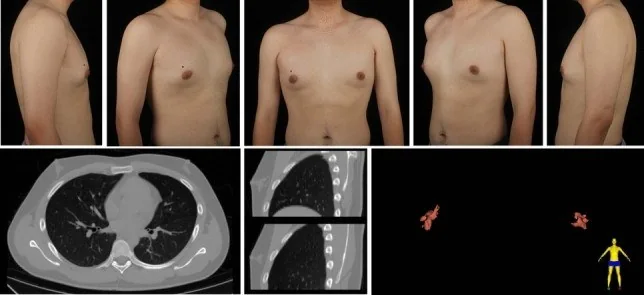 Jinekomasti: yayımlanmış olgu görüntüsü, aksiyel kesit