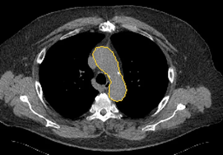 Bölge anatomisi, BT kesiti: Aorta sınırı sarı çizgiyle işaretli