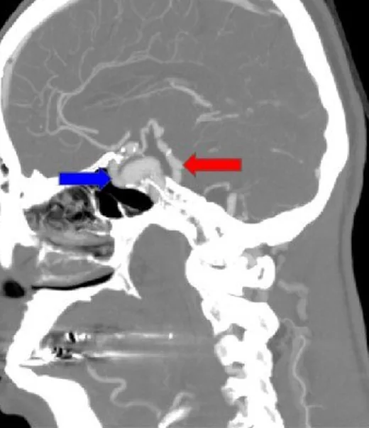 Fuziform anevrizma: yayımlanmış olgu görüntüsü, sagittal+aksiyel+koronal kesit