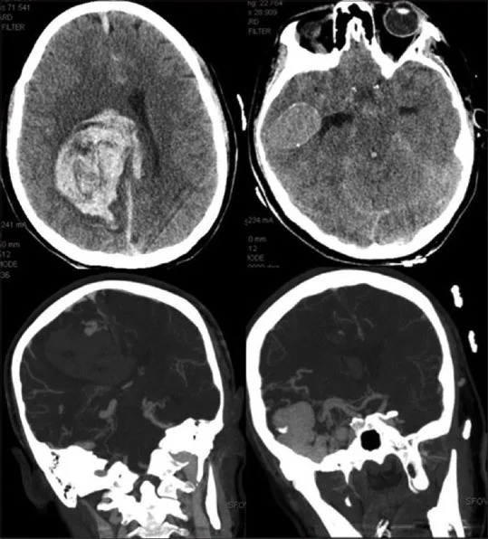 Pial arteriovenöz fistül: yayımlanmış olgu görüntüsü, koronal kesit