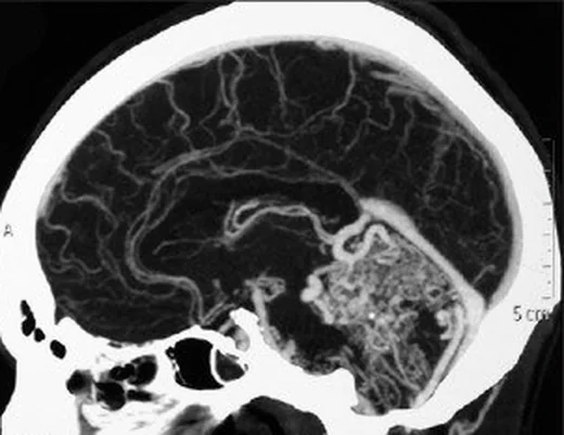 Serebral proliferatif anjiyopati: yayımlanmış olgu görüntüsü, aksiyel kesit