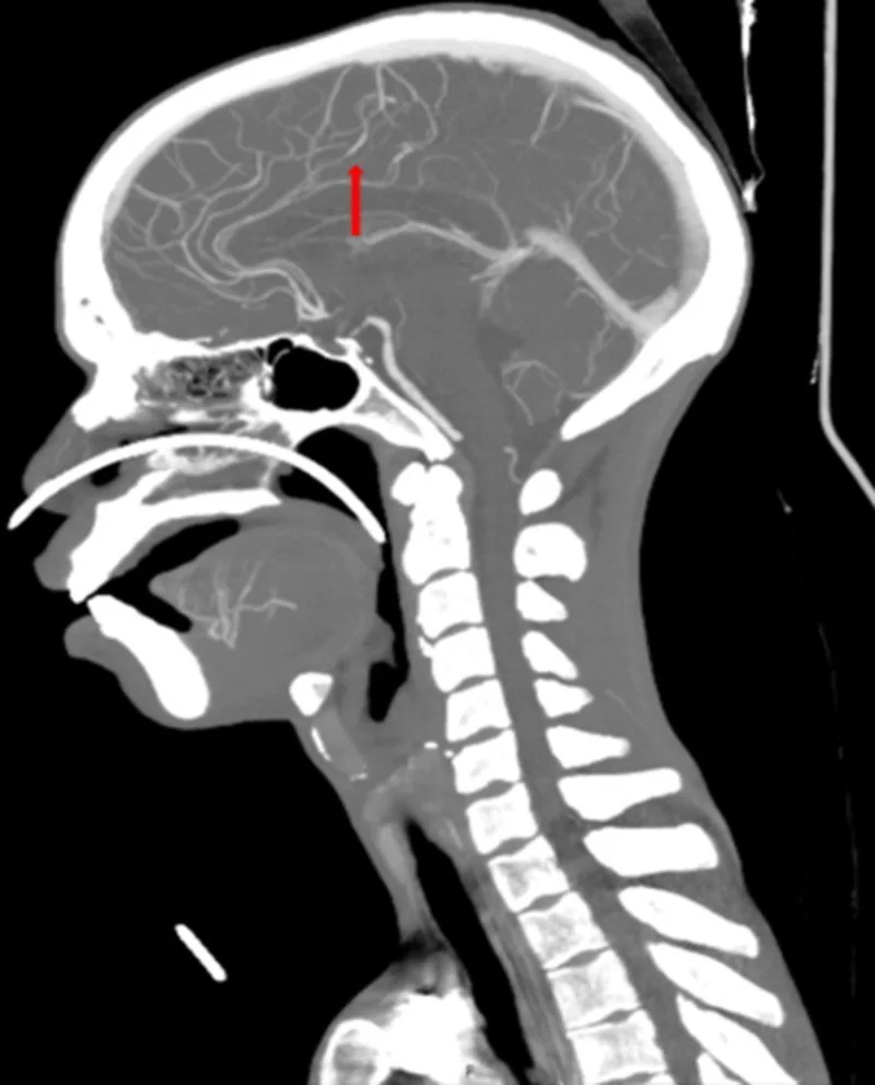 İntrakraniyal vaskülopati/vaskülit görünümü: yayımlanmış olgu görüntüsü, sagittal kesit
