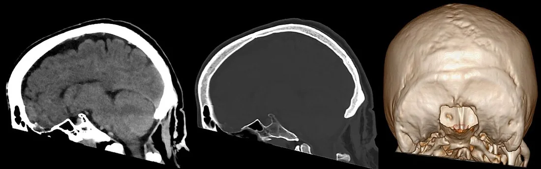 Chiari I malformasyonu: yayımlanmış olgu görüntüsü, sagittal kesit