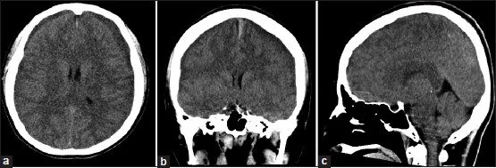 İntrakraniyal hipotansiyonun BT bulguları: yayımlanmış olgu görüntüsü, aksiyel|koronal|sagittal kesit