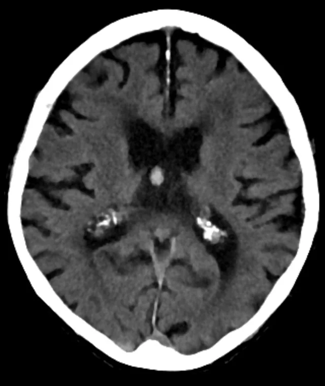 Foramen Monro düzeyinde kolloid kist obstrüksiyonu: yayımlanmış olgu görüntüsü, aksiyel+koronal kesit