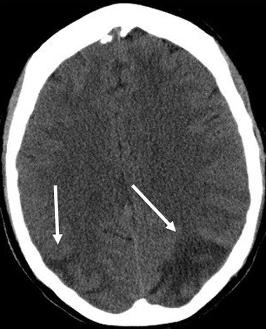 Posterior reversible ensefalopati sendromu: BT görünümü: yayımlanmış olgu görüntüsü, aksiyel kesit